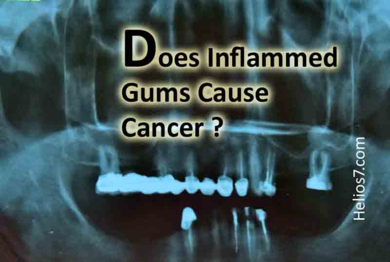 does periodontitis cause cancer